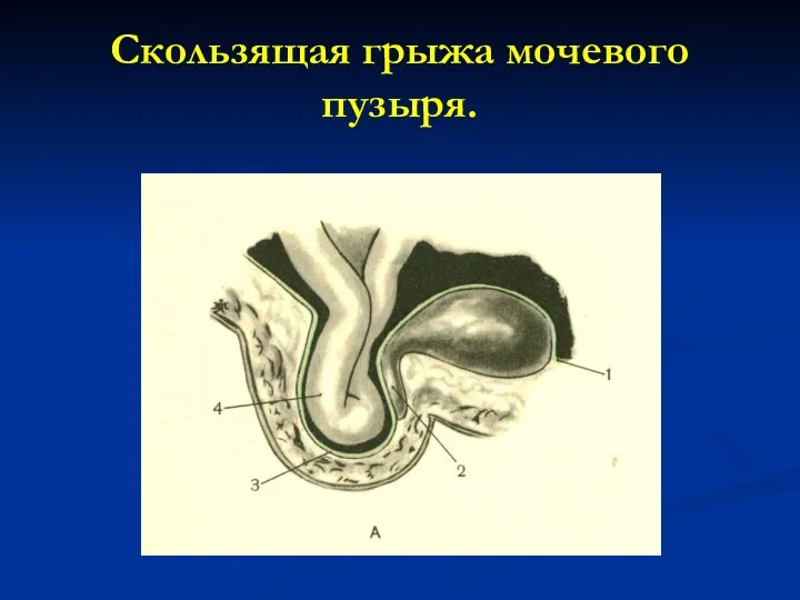 Скользящая грыжа мочевого пузыря.