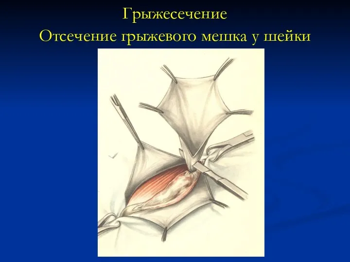 Грыжесечение Отсечение грыжевого мешка у шейки