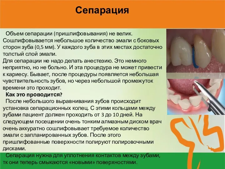 Сепарация Объем сепарации (пришлифовывания) не велик. Сошлифовывается небольшое количество эмали с