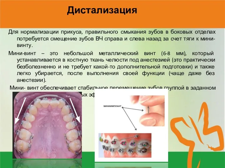 Дистализация Для нормализации прикуса, правильного смыкания зубов в боковых отделах потребуется