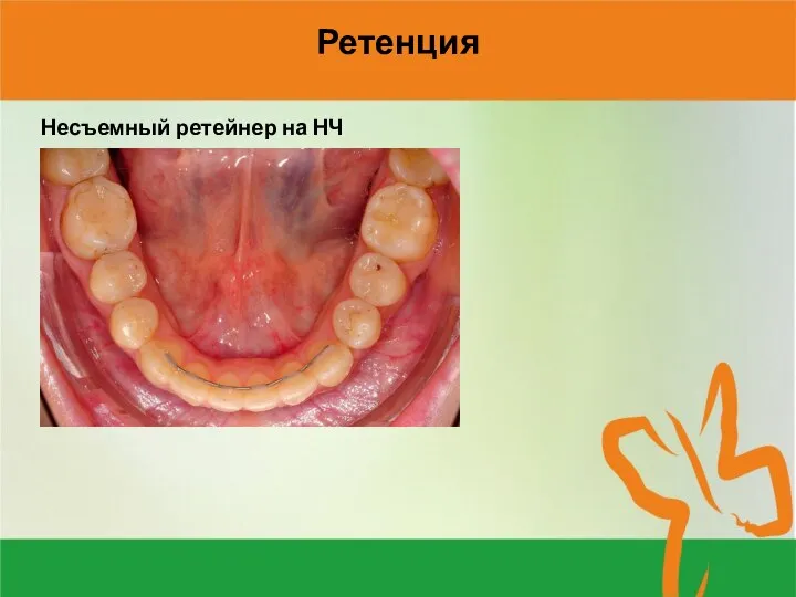 Ретенция Несъемный ретейнер на НЧ