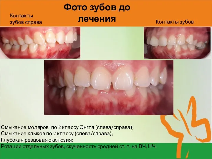 Фото зубов до лечения Смыкание моляров по 2 классу Энгля (слева/справа);