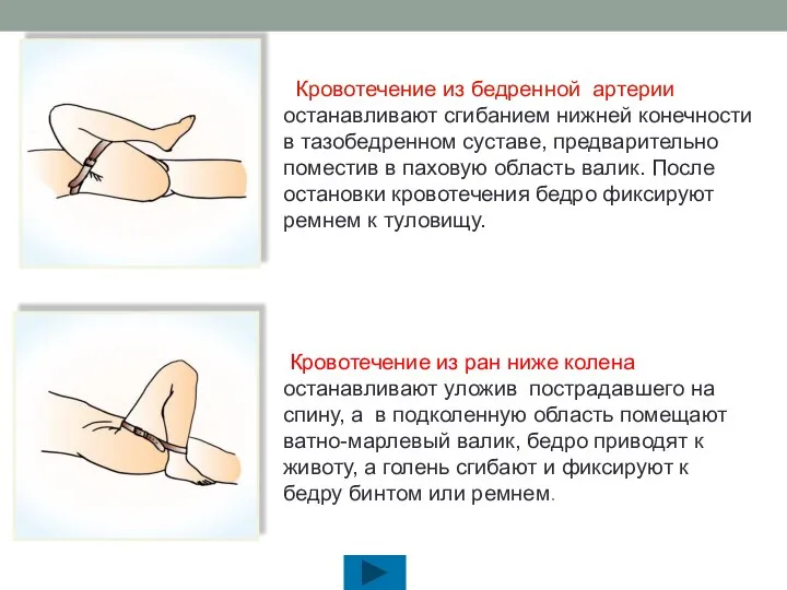 Кровотечение из бедренной артерии останавливают сгибанием нижней конечности в тазобедренном суставе,