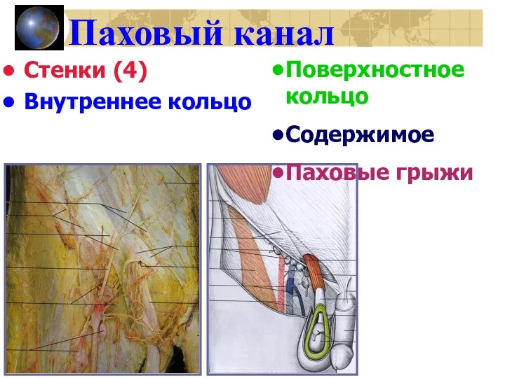 Паховый канал Стенки (4) Внутреннее кольцо Поверхностное кольцо Содержимое Паховые грыжи