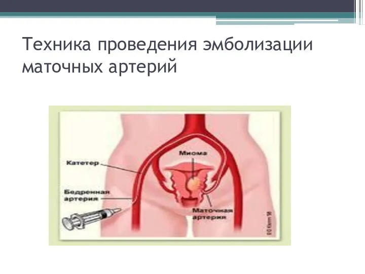 Техника проведения эмболизации маточных артерий