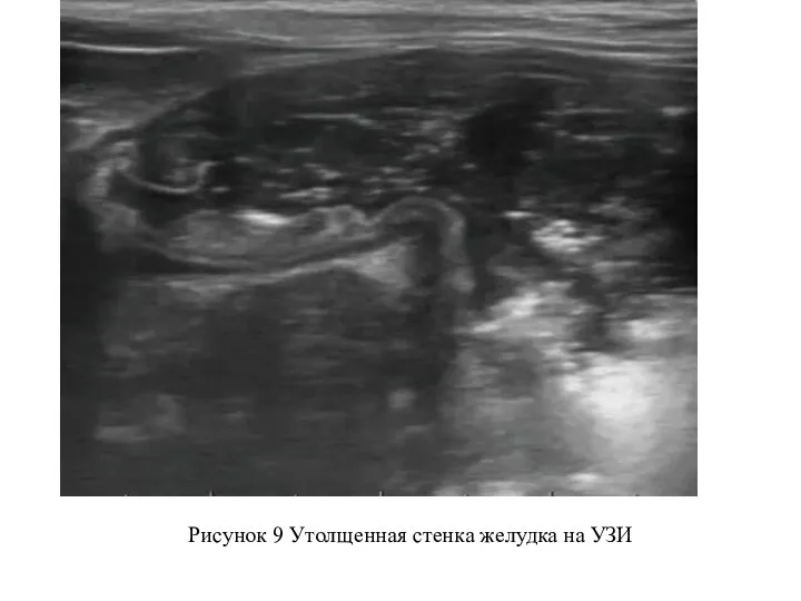 Рисунок 9 Утолщенная стенка желудка на УЗИ