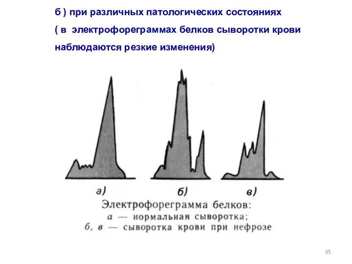 б ) при различных патологических состояниях ( в электрофореграммах белков сыворотки крови наблюдаются резкие изменения)