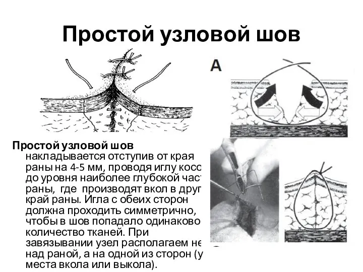 Простой узловой шов Простой узловой шов накладывается отступив от края раны