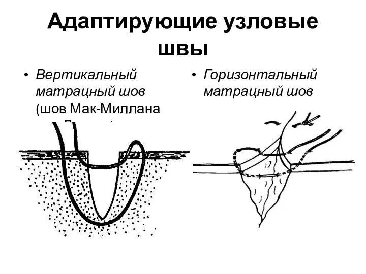 Адаптирующие узловые швы Вертикальный матрацный шов (шов Мак-Миллана или Донати) Горизонтальный матрацный шов