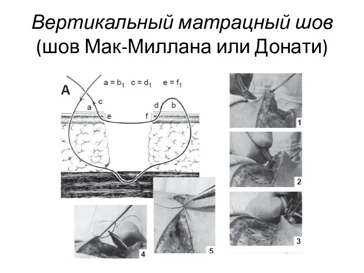 Вертикальный матрацный шов (шов Мак-Миллана или Донати)