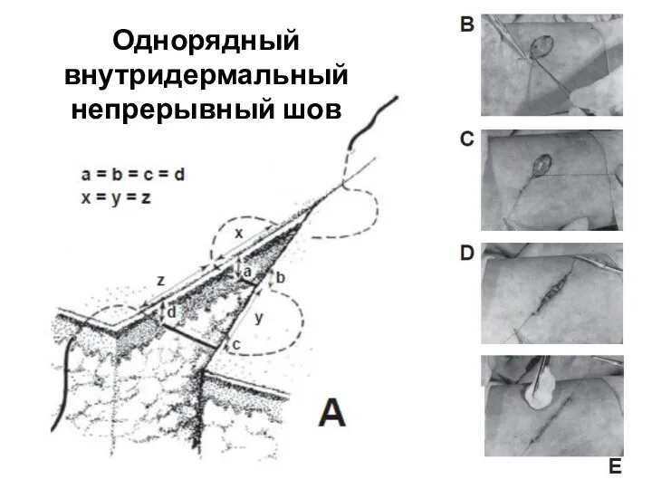 Однорядный внутридермальный непрерывный шов