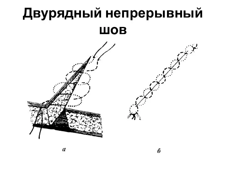 Двурядный непрерывный шов