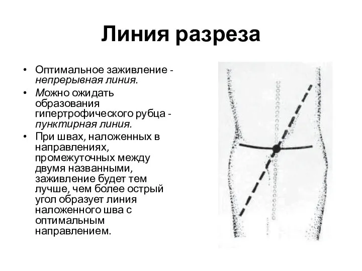 Линия разреза Оптимальное заживление - непрерывная линия. Можно ожидать образования гипертрофического