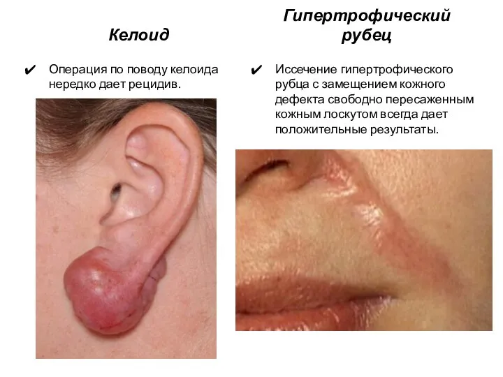 Келоид Операция по поводу келоида нередко дает рецидив. Гипертрофический рубец Иссечение