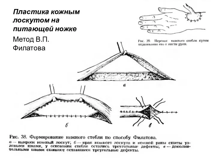 Пластика кожным лоскутом на питающей ножке Метод В.П.Филатова