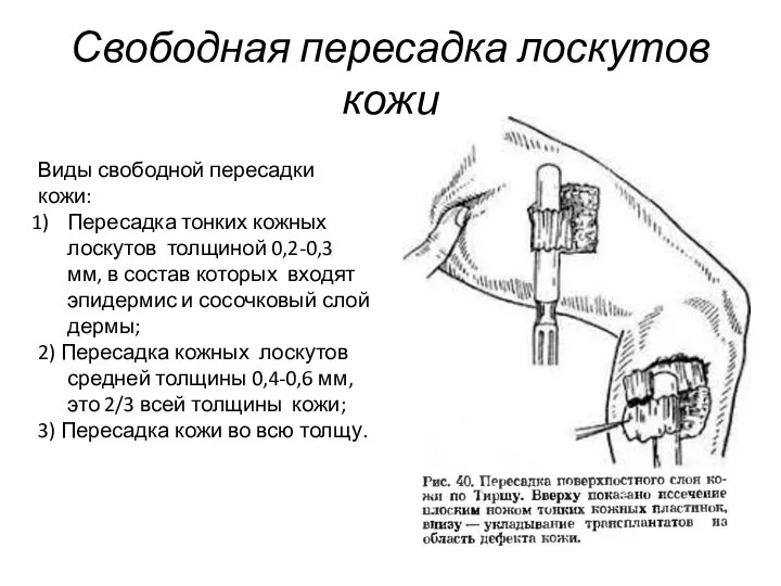 Свободная пересадка лоскутов кожи Виды свободной пересадки кожи: Пересадка тонких кожных