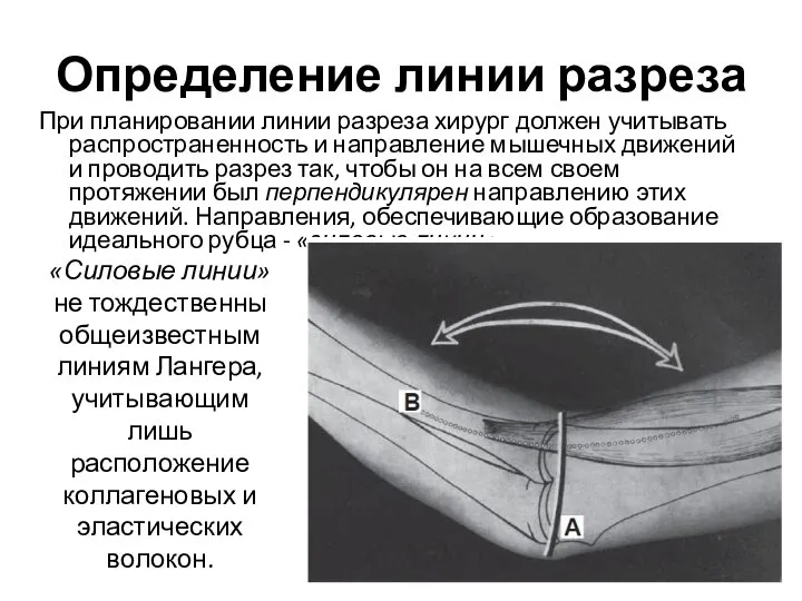 Определение линии разреза При планировании линии разреза хирург должен учитывать распространенность