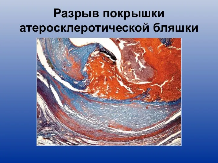 Разрыв покрышки атеросклеротической бляшки