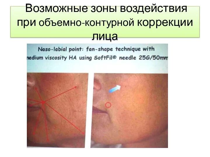 Возможные зоны воздействия при объемно-контурной коррекции лица