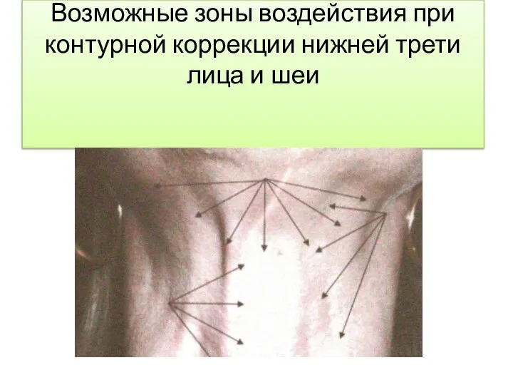 Возможные зоны воздействия при контурной коррекции нижней трети лица и шеи