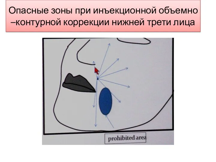 Опасные зоны при инъекционной объемно –контурной коррекции нижней трети лица