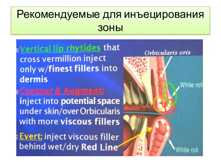 Рекомендуемые для инъецирования зоны