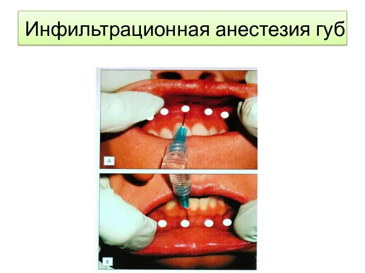 Инфильтрационная анестезия губ