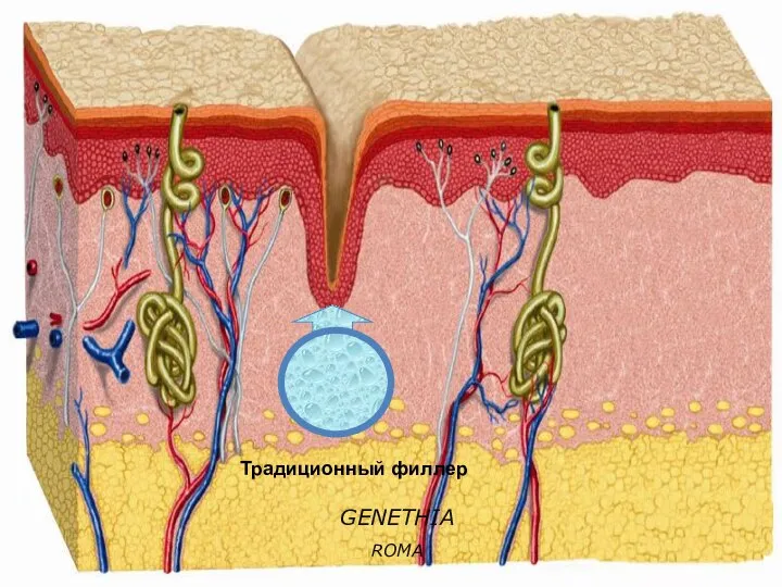 GENETHIA ROMA Традиционный филлер