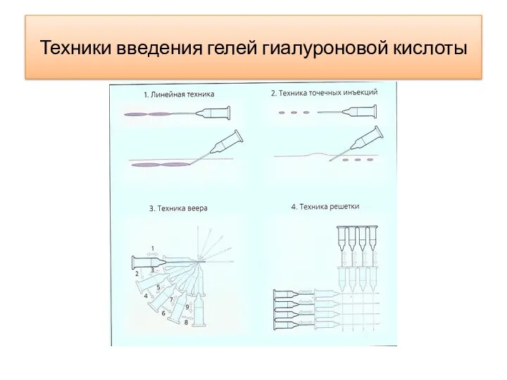 Техники введения гелей гиалуроновой кислоты