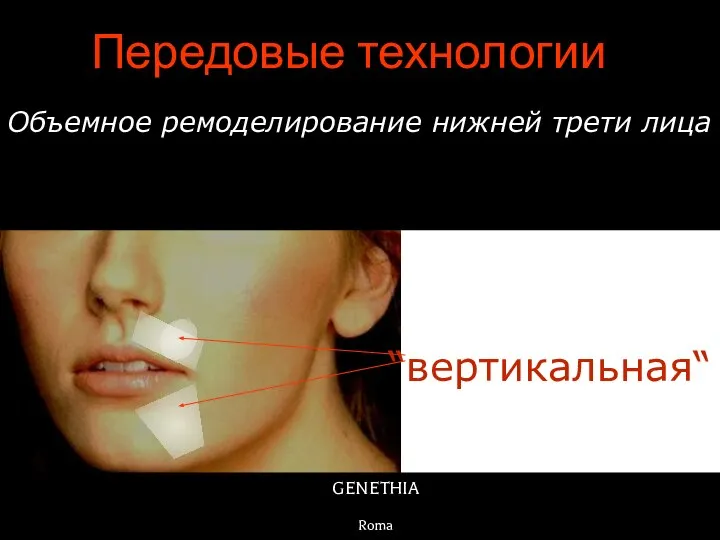 GENETHIA Roma Передовые технологии Объемное ремоделирование нижней трети лица Техника “вертикальная“