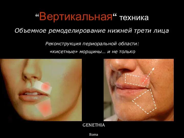 GENETHIA Roma Объемное ремоделирование нижней трети лица “Вертикальная“ техника Реконструкция периоральной