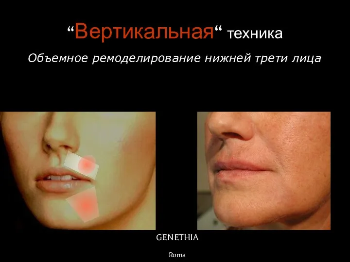 GENETHIA Roma “Вертикальная“ техника Объемное ремоделирование нижней трети лица