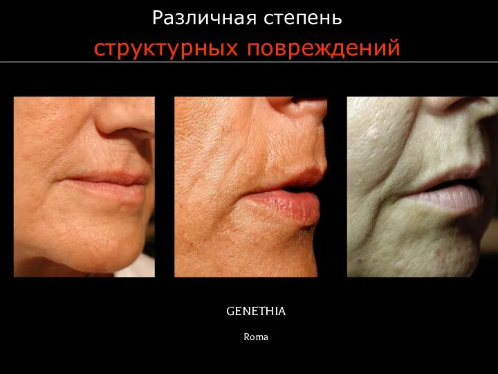 GENETHIA Roma Различная степень структурных повреждений