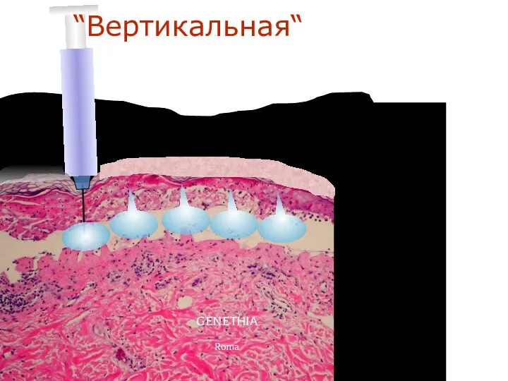 GENETHIA Roma “Вертикальная“ техника