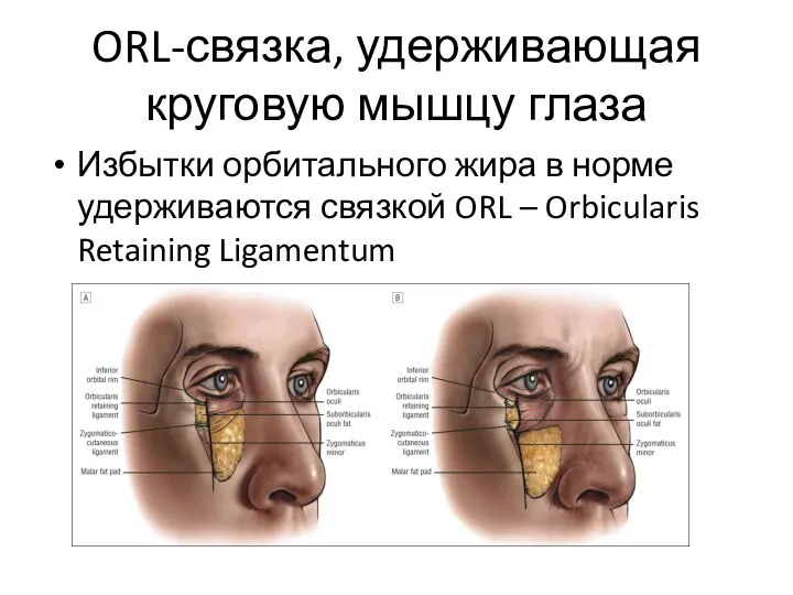 ORL-связка, удерживающая круговую мышцу глаза Избытки орбитального жира в норме удерживаются