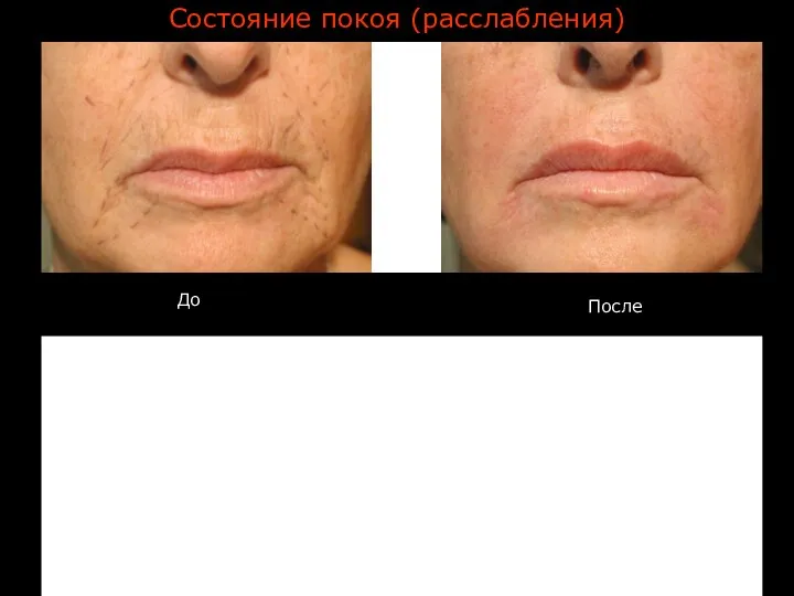 GENETHIA Roma Состояние покоя (расслабления) До После