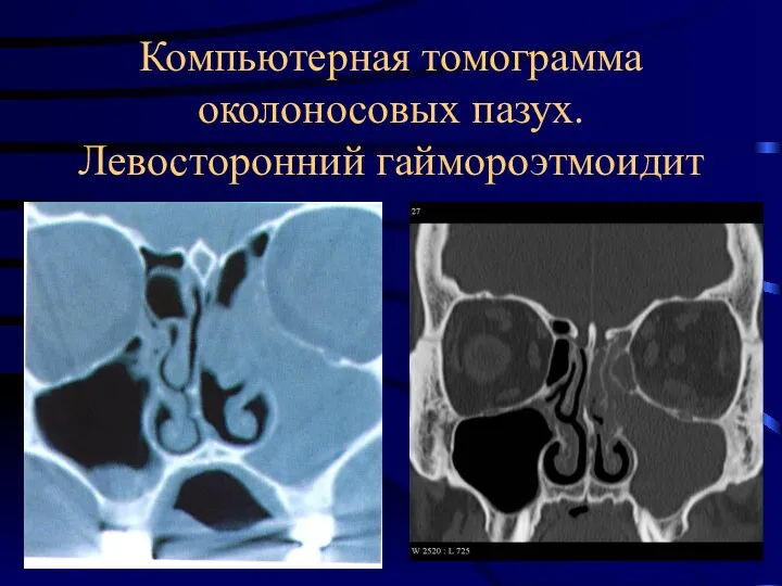 Компьютерная томограмма околоносовых пазух. Левосторонний гаймороэтмоидит