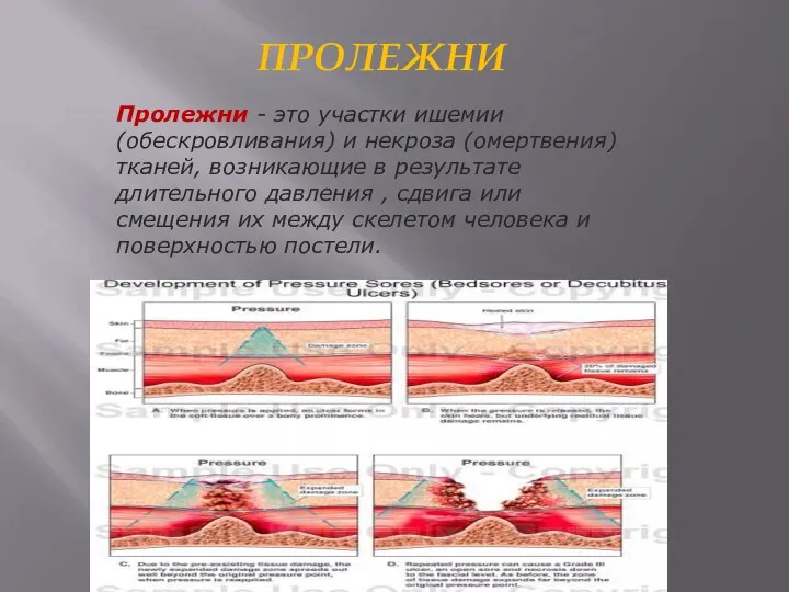 ПРОЛЕЖНИ Пролежни - это участки ишемии (обескровливания) и некроза (омертвения) тканей,