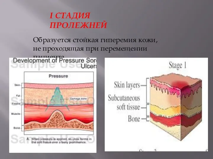 I СТАДИЯ ПРОЛЕЖНЕЙ Образуется стойкая гиперемия кожи, не проходящая при перемещении пациента