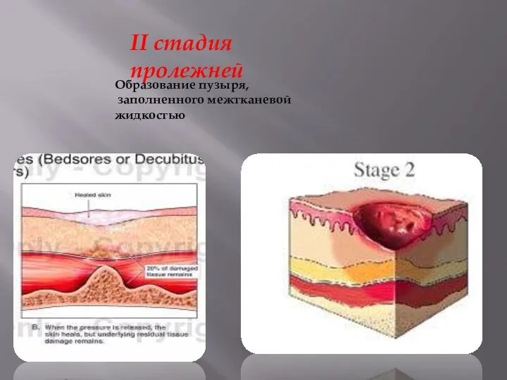 II стадия пролежней Образование пузыря, заполненного межтканевой жидкостью