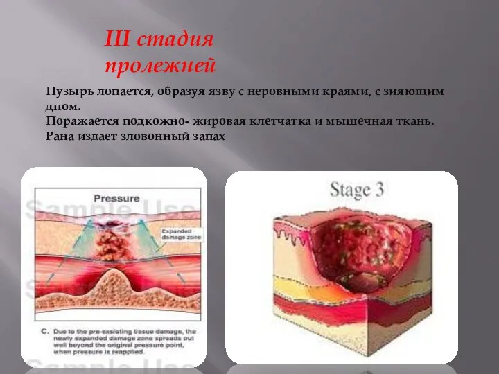 III стадия пролежней Пузырь лопается, образуя язву с неровными краями, с