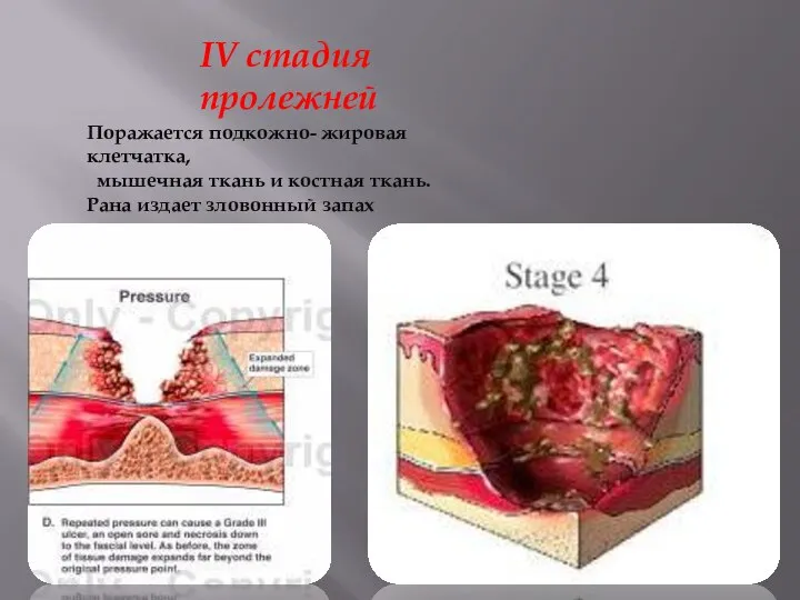 IV стадия пролежней Поражается подкожно- жировая клетчатка, мышечная ткань и костная ткань. Рана издает зловонный запах