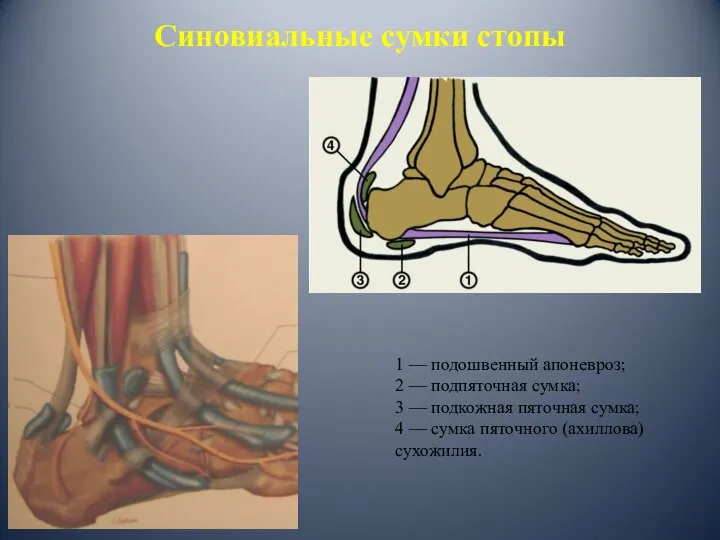 1 — подошвенный апоневроз; 2 — подпяточная сумка; 3 — подкожная