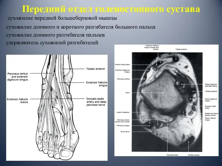 Передний отдел голеностопного сустава сухожилие передней большеберцовой мышцы сухожилие длинного и