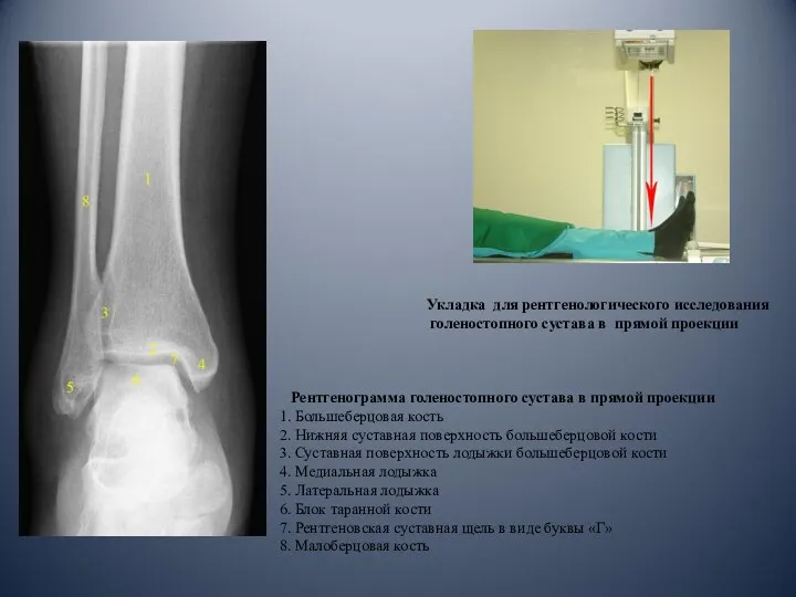 Укладка для рентгенологического исследования голеностопного сустава в прямой проекции Рентгенограмма голеностопного