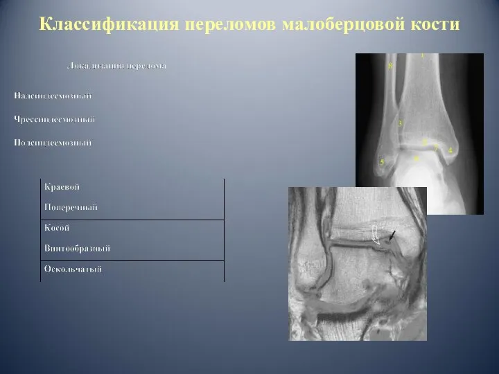 Классификация переломов малоберцовой кости