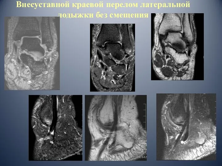 Внесуставной краевой перелом латеральной лодыжки без смещения