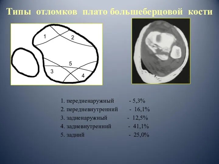 Типы отломков плато большеберцовой кости 1. передненаружный - 5,3% 2. передневнутренний