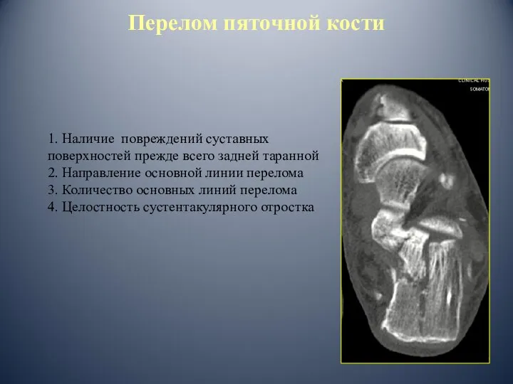 1. Наличие повреждений суставных поверхностей прежде всего задней таранной 2. Направление