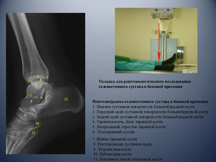 Укладка для рентгенологического исследования голеностопного сустава в боковой проекции Рентгенограмма голеностопного
